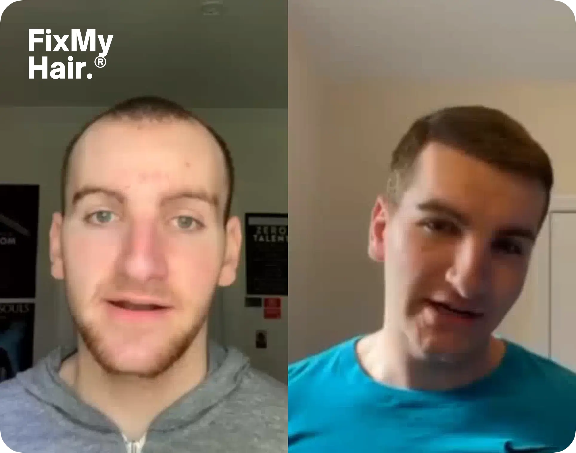 hair transplant after before