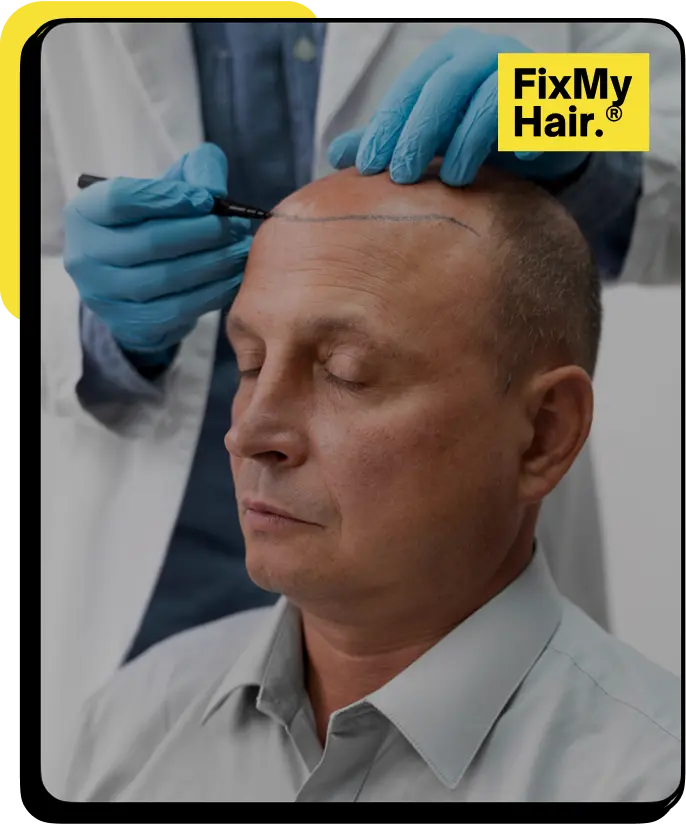 hair transplant fixmyhair