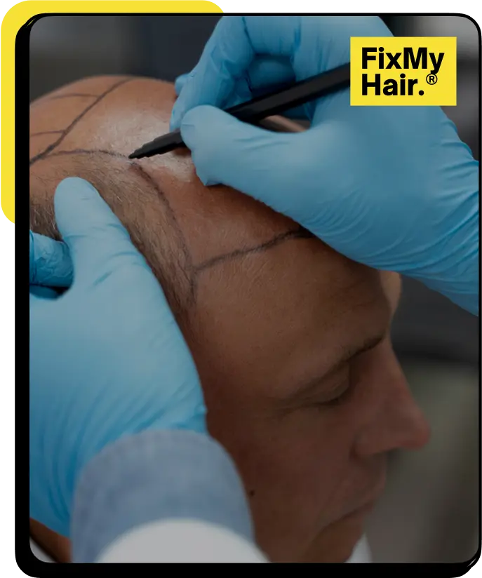 1 hair transplant fixmyhair