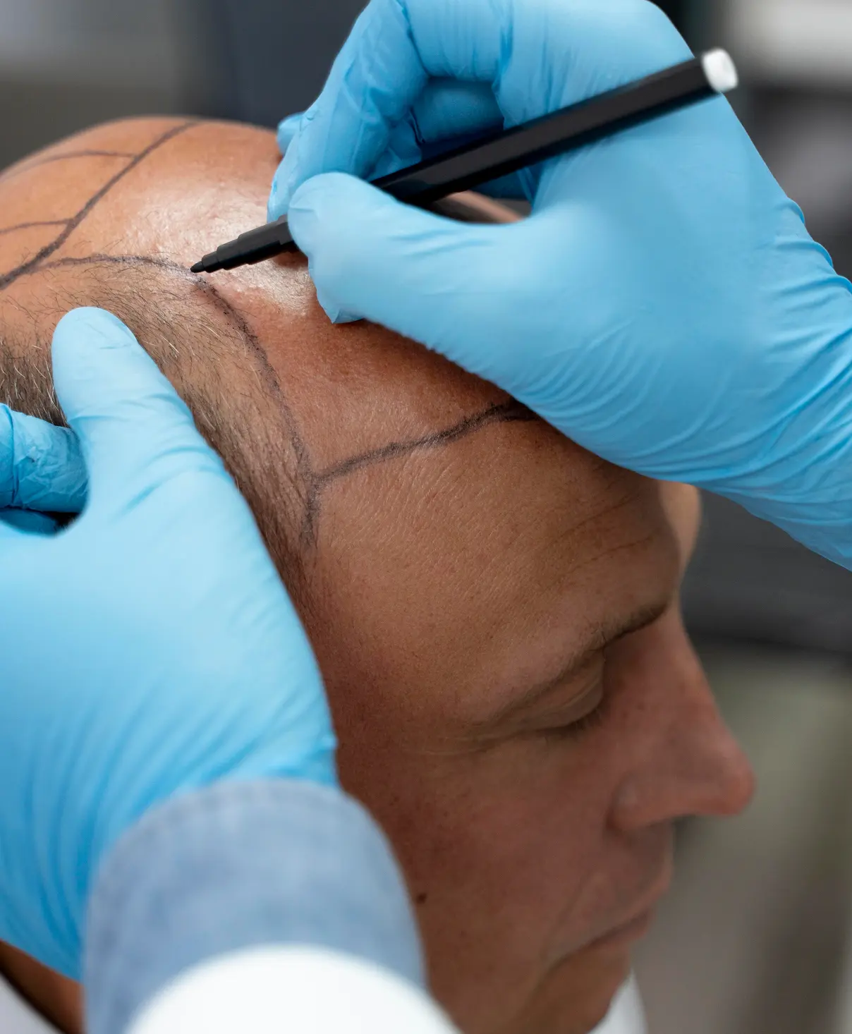 Male undergoing hair transplant.