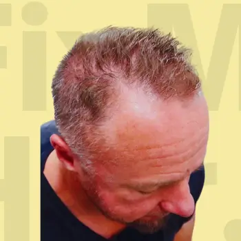 Before Hair Transformation Result