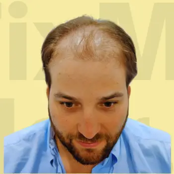 before taking hair treatment