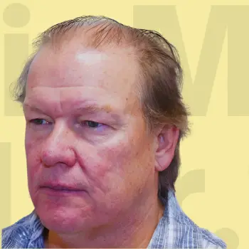 Before Hair Transformation Result