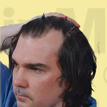 Before Hair Transformation Result