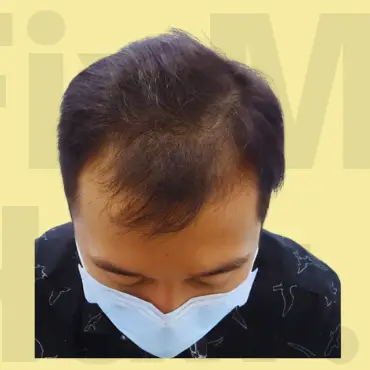 Before Hair Treatment Result