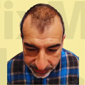 Before Hair Transformation Result