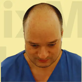 Before hair transformation result