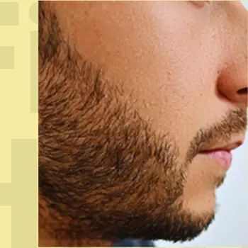 Hair Transformation After Photo