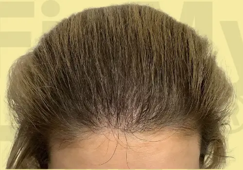 After Hair Treatment Result