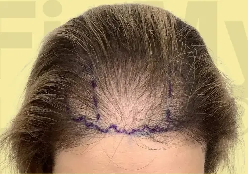 Before and after results