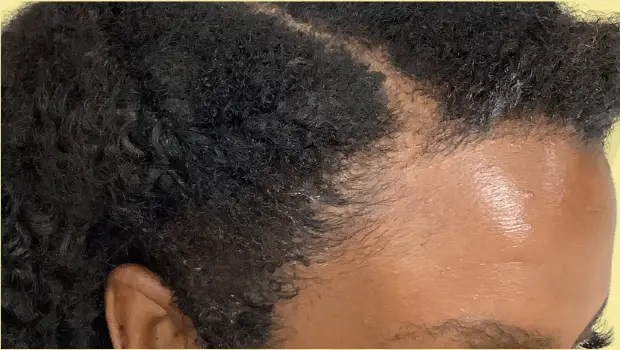 Results After Hair Transformation