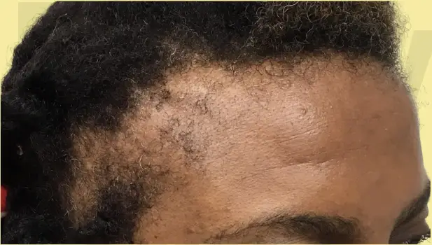 Before hair transformation result