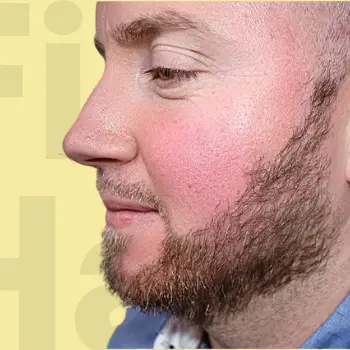 after taking the hair transplant treament with Fix My Hair UK