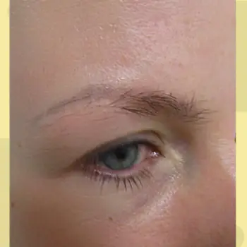 Before Hair Transformation Results