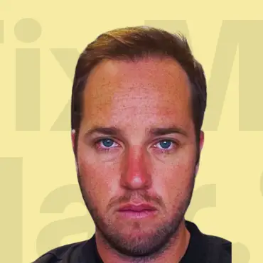 Hair Growth Results After Treatment