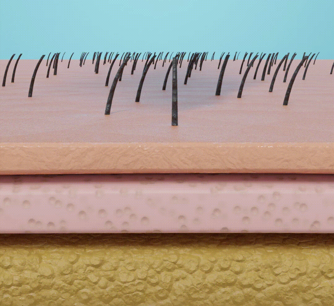 Hair transplant procedure.