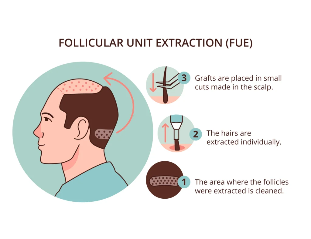 guide Hair Transplant Clinic in UK